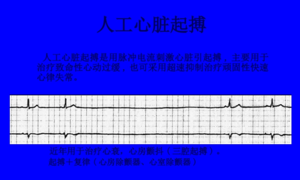 人工心脏起搏03417ppt.pptx