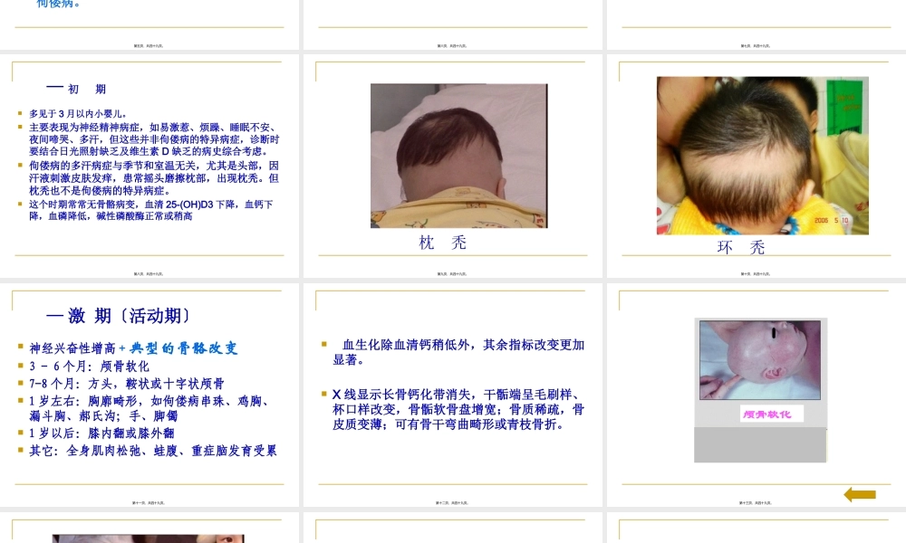 佝偻病-王沪荣.pptx