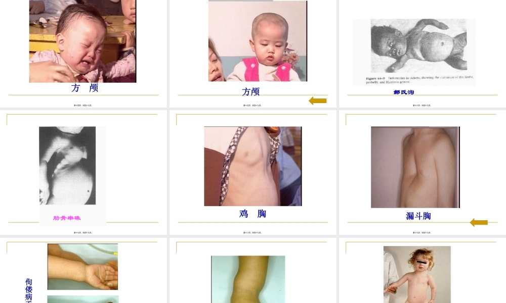 佝偻病-王沪荣.pptx