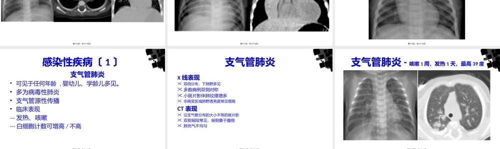 儿童常见肺部感染.pptx