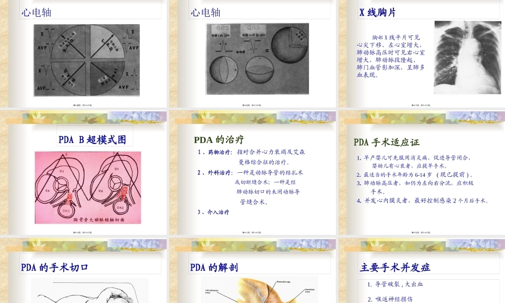 先天性心脏病模板.pptx