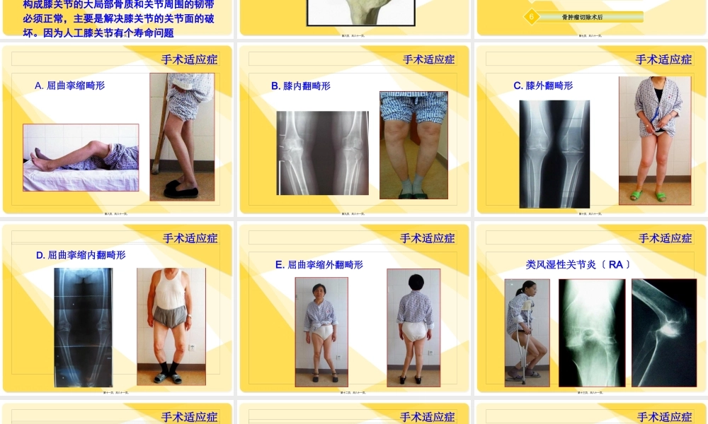 全膝关节置换术后康复.pptx