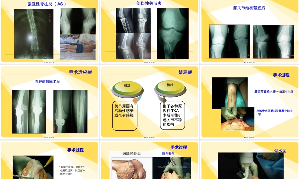 全膝关节置换术后康复.pptx