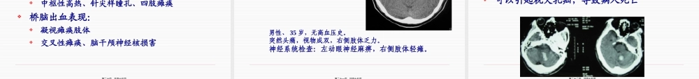 出血性脑血管病s1-PPT文档.pptx