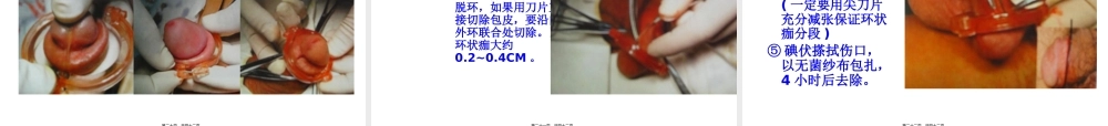 包皮环切手术方式.pptx