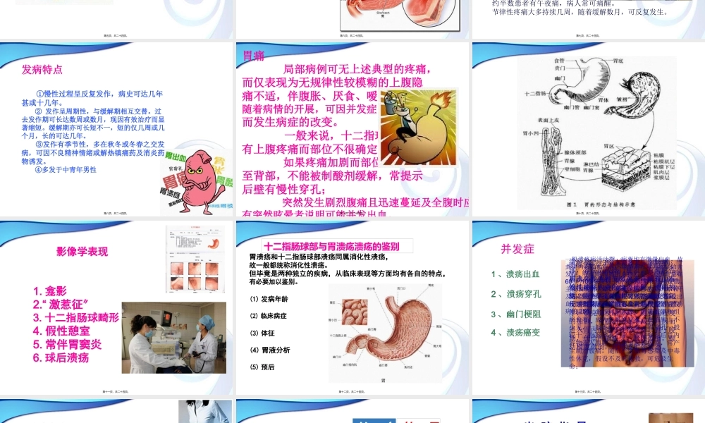 十二指肠球部溃疡.pptx