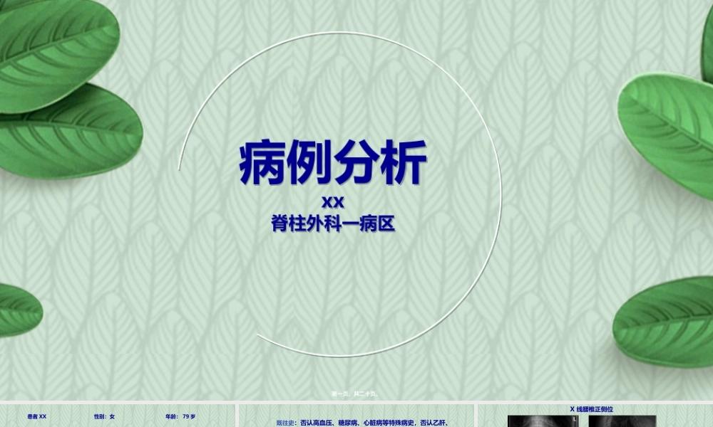 压缩性骨折病例分析.ppt