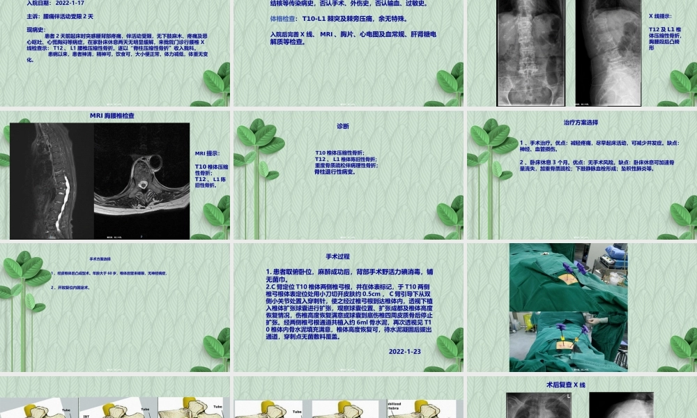 压缩性骨折病例分析.ppt