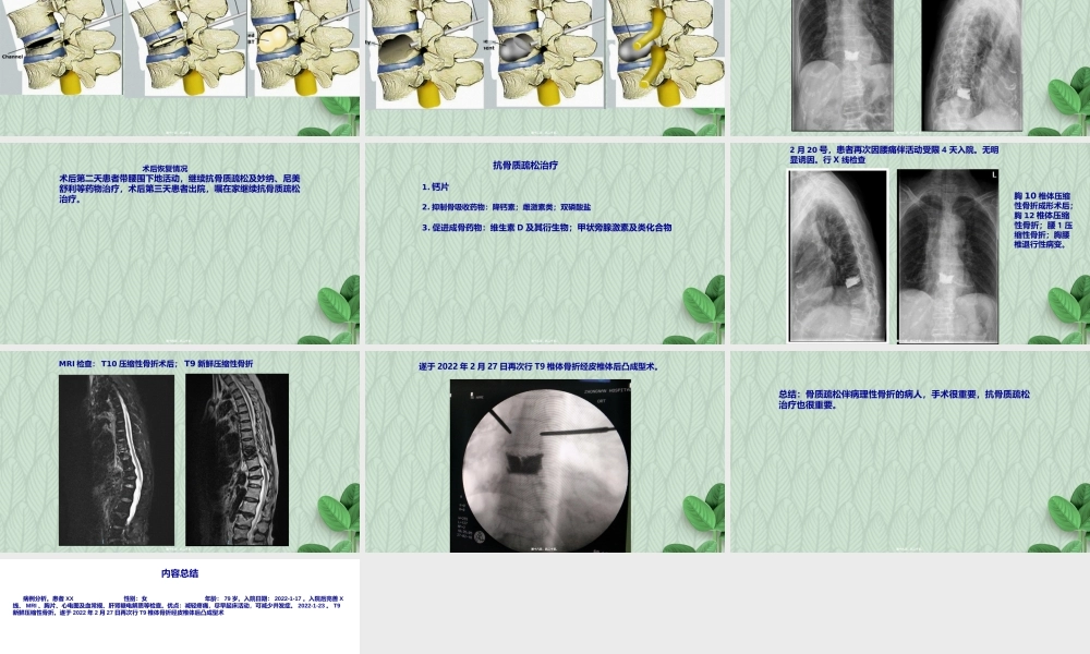 压缩性骨折病例分析.ppt
