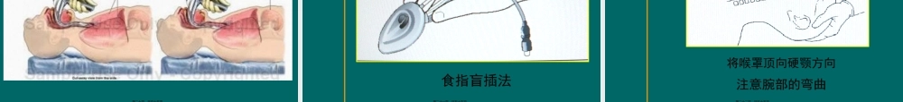喉罩的使用资料.pptx