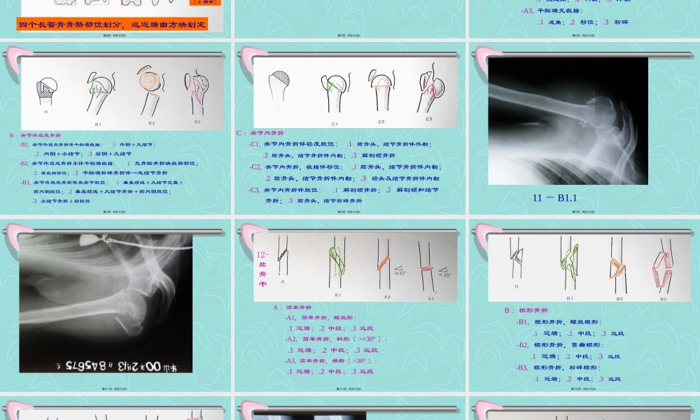 四肢长管状骨的-AO-综合分类.pptx