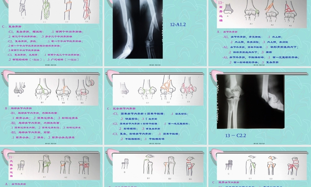 四肢长管状骨的-AO-综合分类.pptx