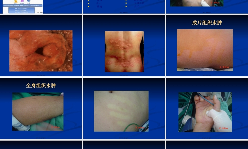 围手术期过敏反应-10-13李雅兰.pptx