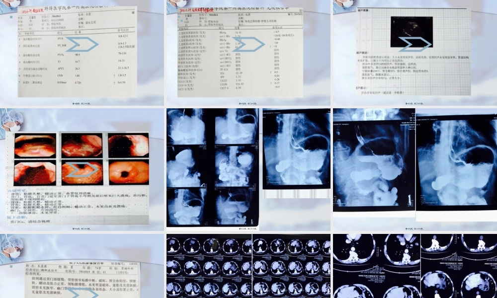 围手术期脑梗.pptx