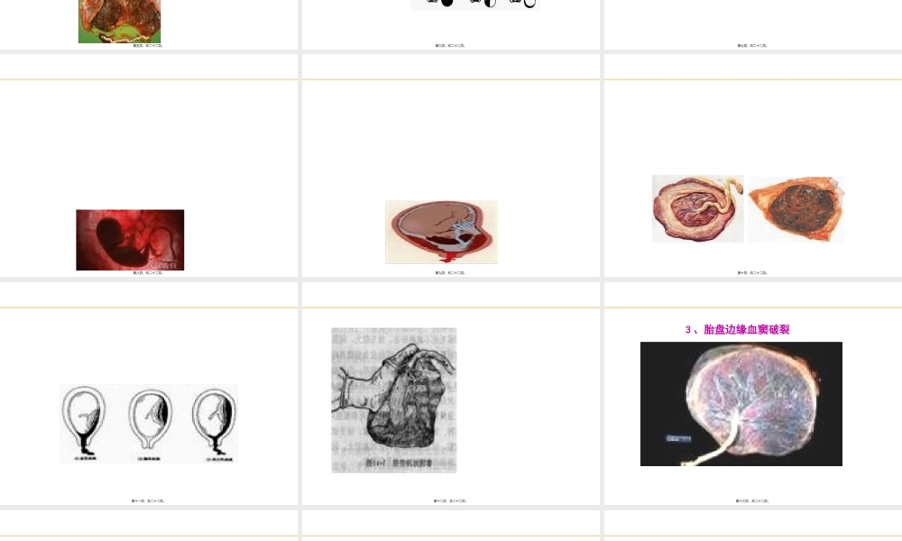 妊娠并发症之前置胎盘.pptx