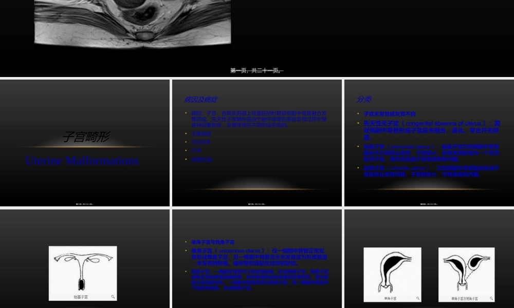 子宫畸形.ppt