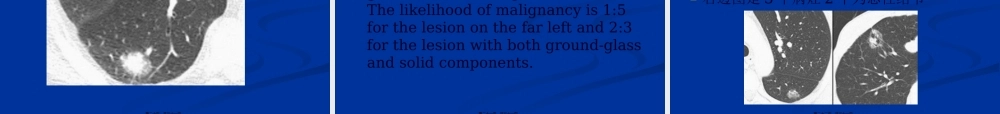孤立性肺结节：良性与恶性对比..pptx