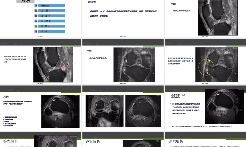 完全性后交叉韧带撕裂-病例分析.ppt