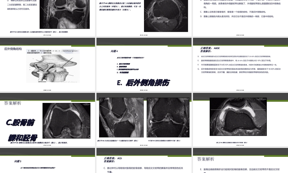 完全性后交叉韧带撕裂-病例分析.ppt