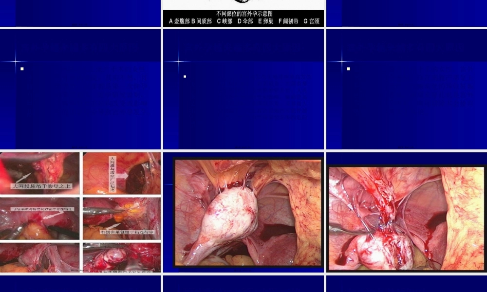 宫外孕病例图片解说.pptx