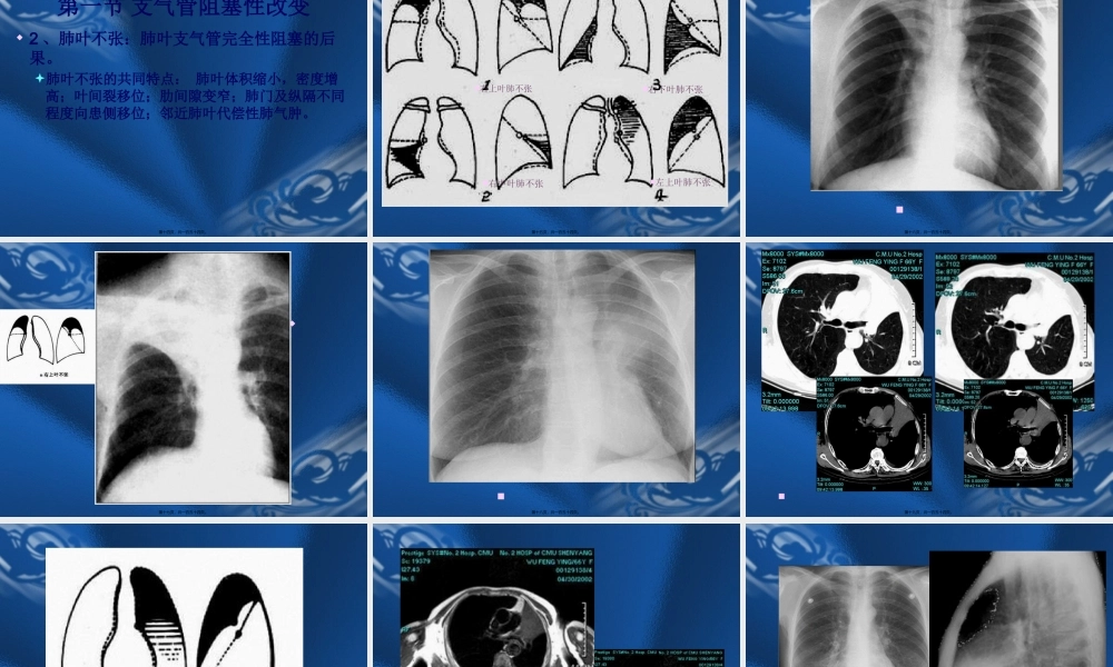 呼吸系统基本病变的影像学改变.pptx
