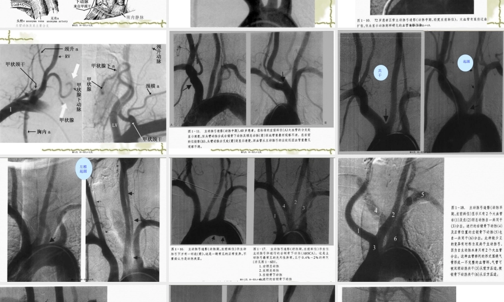 全脑血管造影.pptx
