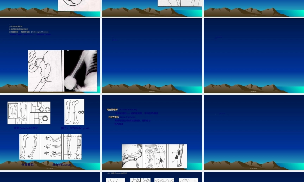 2022年医学专题—.1第六章-第一节骨折概论(1).ppt