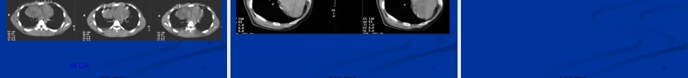 2022年医学专题—CT引导下肺穿刺活检术(1).ppt