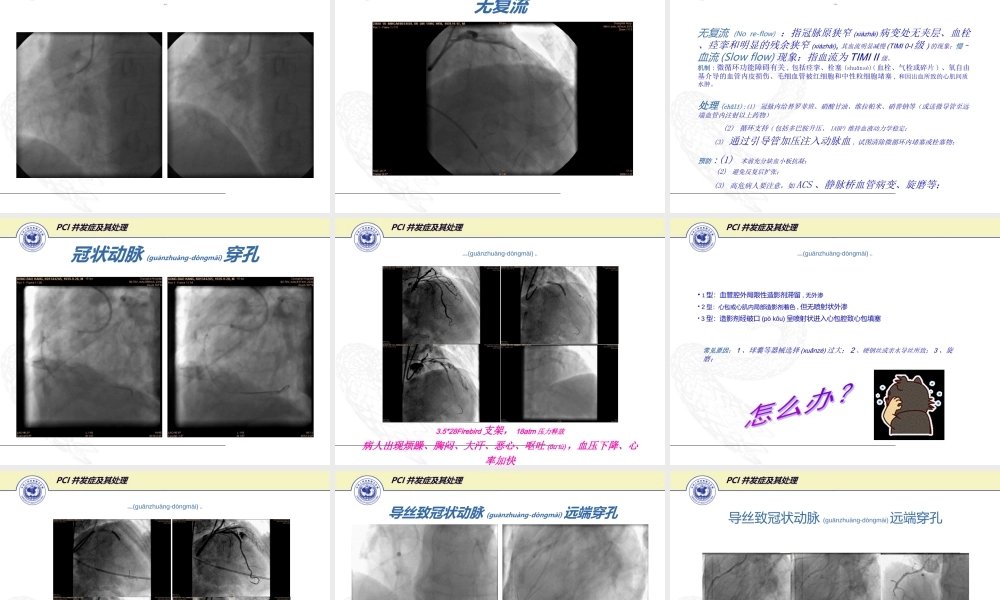 2022年医学专题—PCI的常见并发症的防治(1).ppt