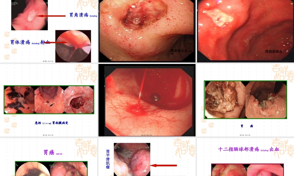 2022年医学专题—xxxttt上消化道出血(1).ppt