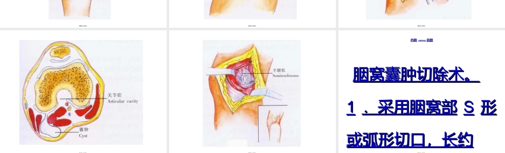 2022年医学专题—[精品]胭窝囊肿除术(1).ppt