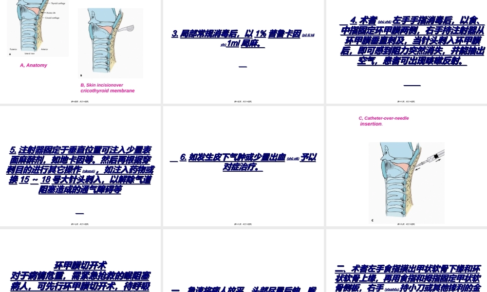 2022年医学专题—【印刷】气管切开术环甲膜穿刺术(1).ppt