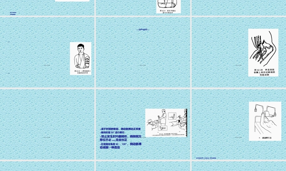 2022年医学专题—上肢骨、关节损伤(1).ppt
