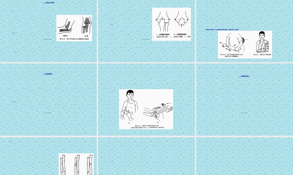 2022年医学专题—上肢骨、关节损伤(1).ppt