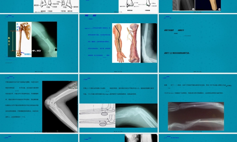 2022年医学专题—上肢骨折及手术配合(1).ppt