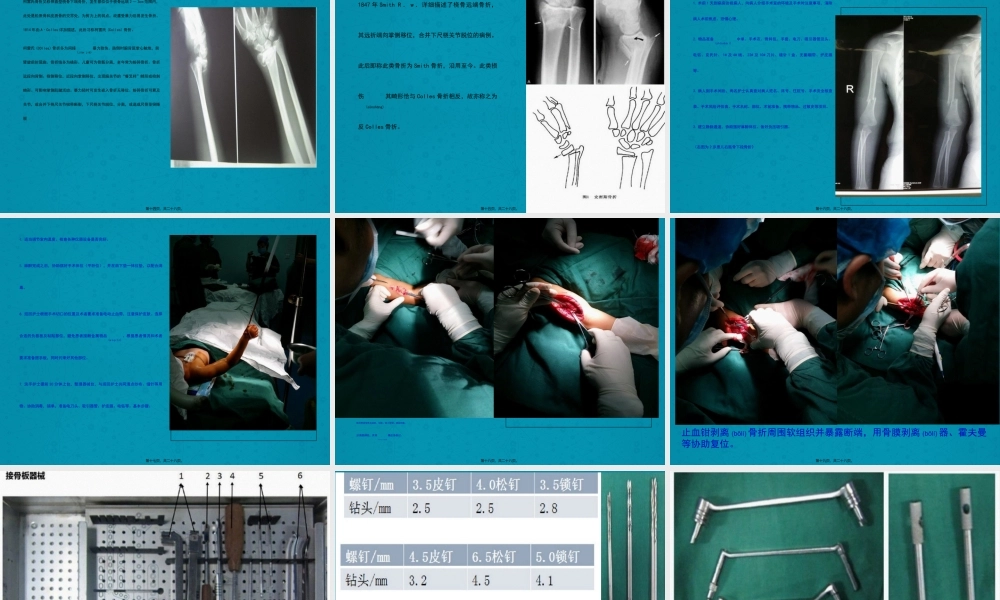 2022年医学专题—上肢骨折及手术配合(1).ppt