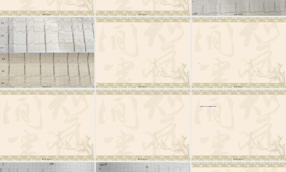 2022年医学专题—不稳定型心绞痛合并甲减1例(1).ppt