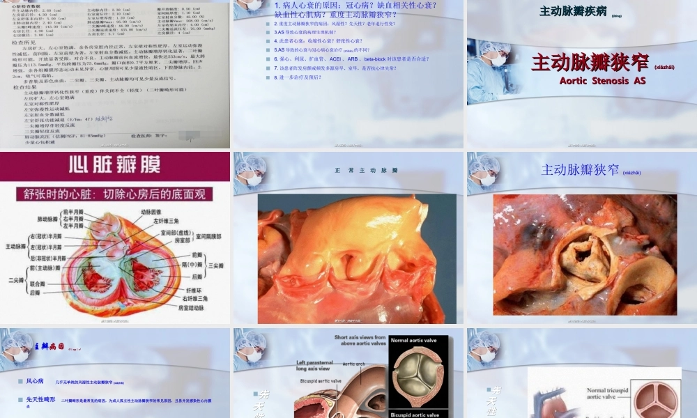2022年医学专题—主动脉瓣狭窄-病例讨论(1).ppt