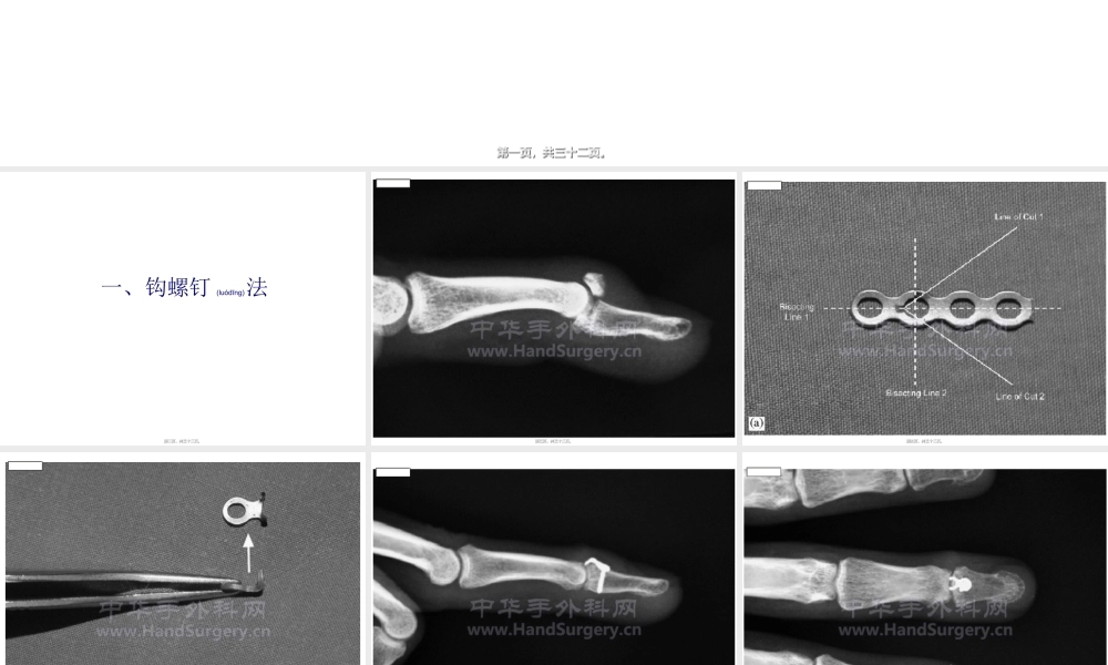 2022年医学专题—伸指肌腱附着的末节指骨基底撕脱骨折3种内固定方式(1).ppt