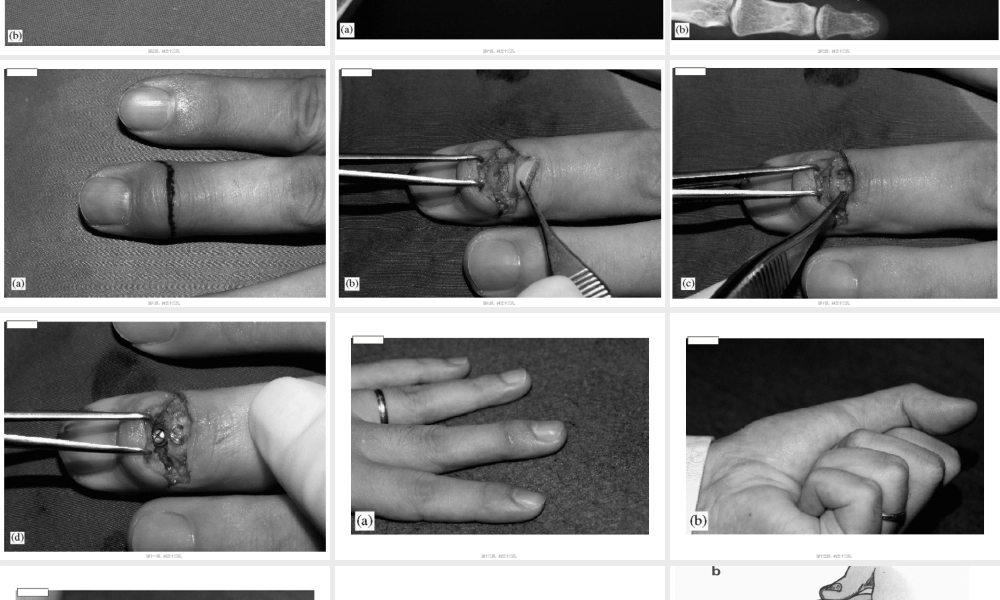 2022年医学专题—伸指肌腱附着的末节指骨基底撕脱骨折3种内固定方式(1).ppt