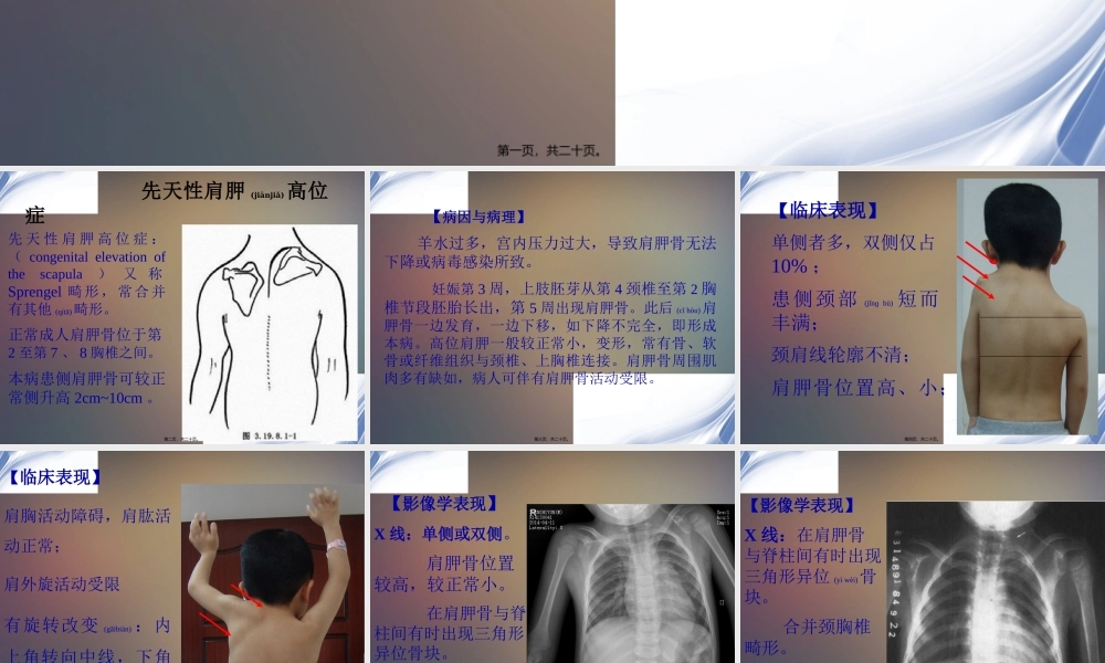2022年医学专题—先天性高肩胛症(1).pptx