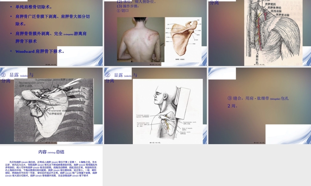 2022年医学专题—先天性高肩胛症(1).pptx