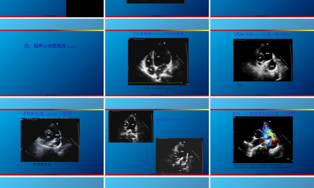 2022年医学专题—动脉导管未闭、主动脉狭窄超声(1).ppt