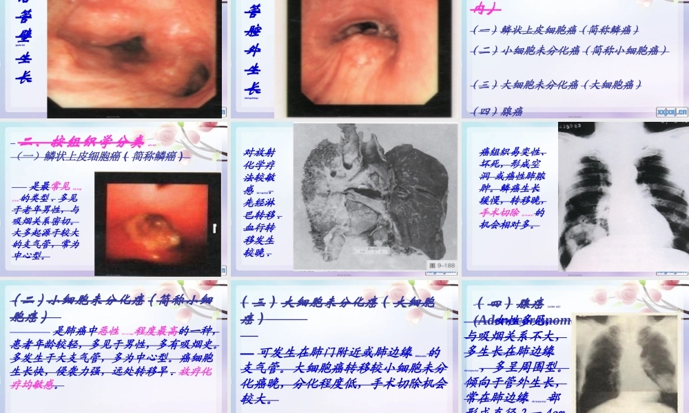 2022年医学专题—原发支气管肺癌1(1).ppt