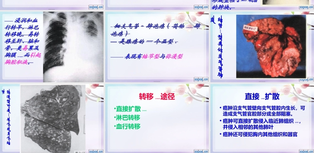 2022年医学专题—原发支气管肺癌1(1).ppt