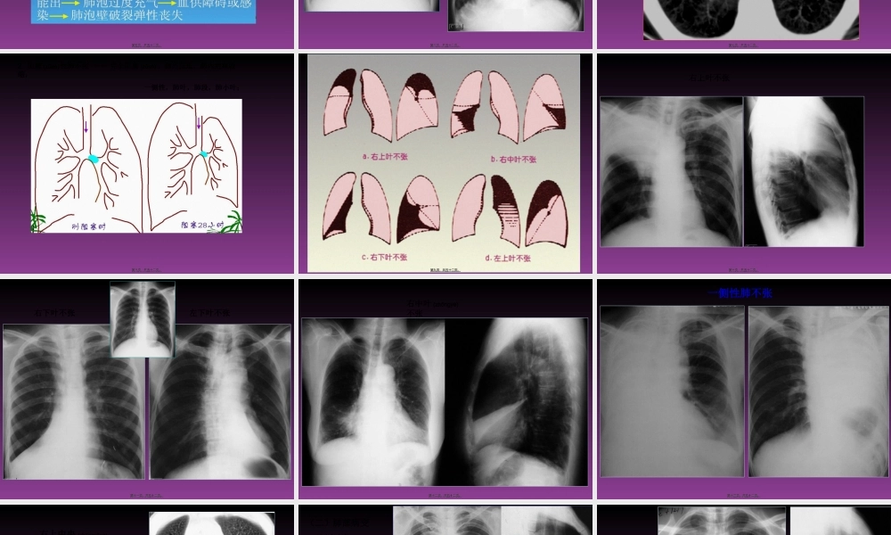 2022年医学专题—呼吸系统X线基本病变(1).ppt