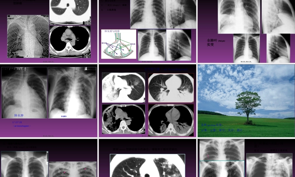 2022年医学专题—呼吸系统X线基本病变(1).ppt