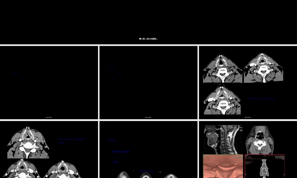 2022年医学专题—喉癌术前及术后影像学评估-夏爽(1).ppt