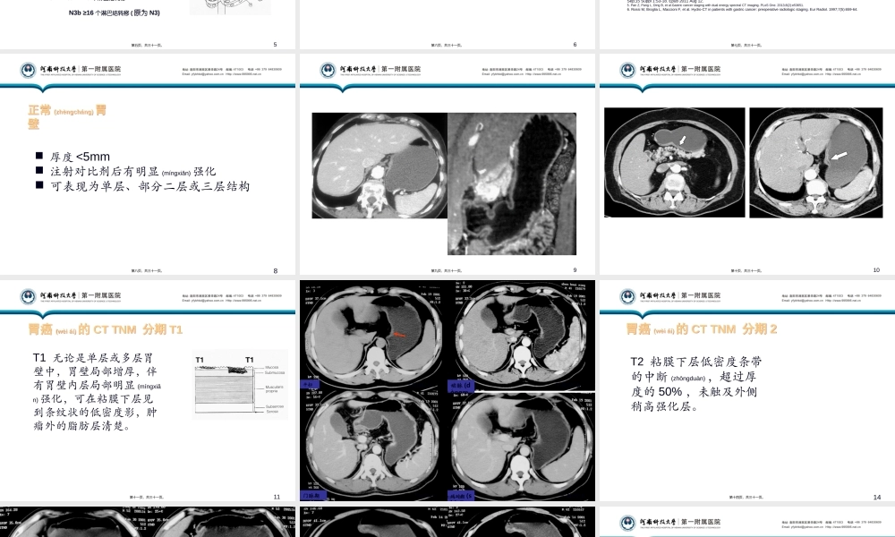 2022年医学专题—增强CT在胃癌TNM分期中的应用(1).ppt