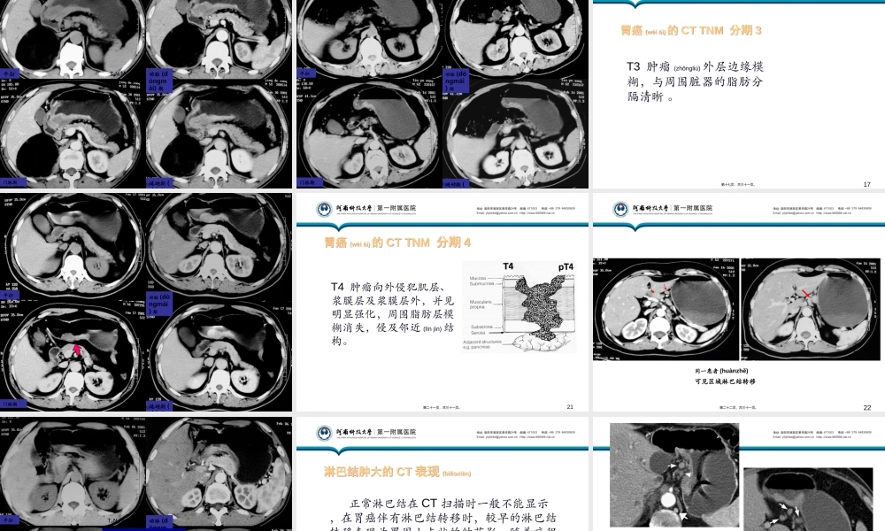 2022年医学专题—增强CT在胃癌TNM分期中的应用(1).ppt